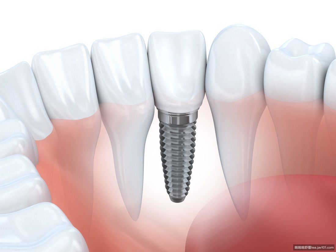 dental-implant-southwood-london-ontario.jpg