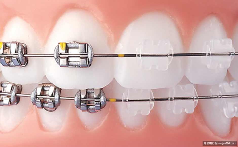 metal-vs-clear-braces454.jpg