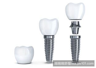 dental-implant-pricing.jpg