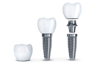 dental-implant-pricing.jpg