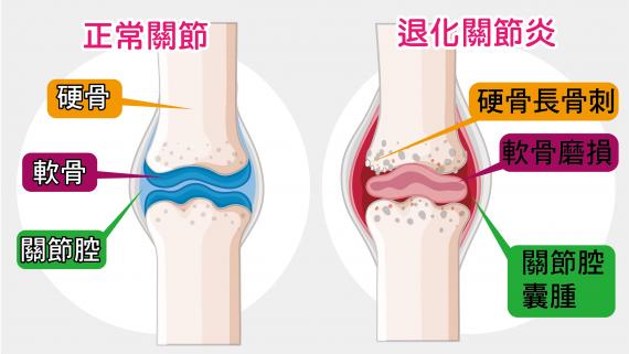 退化性關節炎與正常關結.jpg