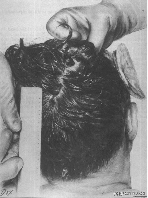 JFK_posterior_head_wound.jpg