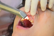 牙科新科技『一日植牙&全瓷冠牙套』治療週期3～5星期缩至一日完成