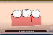 如何預防牙周病或許你該看看專業醫師怎麼說
