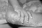 什麼是猴痘：症狀、傳播、防疫觀念一次看
