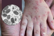 全球迎戰兩大疫情：猴痘蔓延65國，WHO宣佈大流行