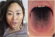 中國染疫者現「恐怖黑臉黑舌」新變種病毒恐誕生