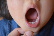4歲童治療蛀牙診所報價「11萬」改找老牙醫竟100元解決
