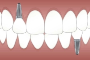 植牙疑問百百種~ 讓我們看澄心美學牙科－鍾芝華醫師怎麼說